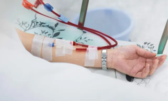 Ramię pacjenta z założonym cewnikiem Sheldona, podłączonym do aparatury dializacyjnej.