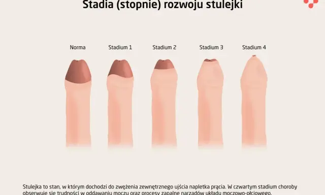 Ilustracja pokazuje, jak wygląda penis w różnych stadiach stulejki, od normy do stadium 4.