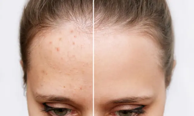 Avant/après : peau acnéique transformée en peau nette. Découvrez par quoi remplacer l'acide salicylique pour une peau parfaite.