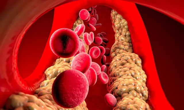 Wysoki cholesterol: Czy masz te objawy? Sprawdź, zanim będzie za późno.