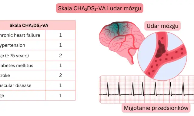 Tabela CHA2DS2-VA, schemat mózgu z udarem, naczynie krwionośne z zakrzepem i EKG.