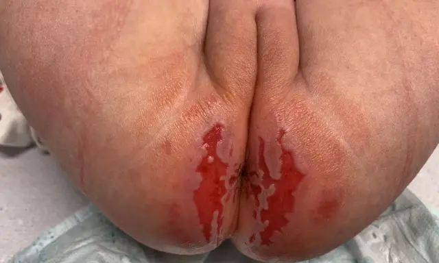 Pelle arrossata e irritata, con aree umide e lucide, tipica della dermatite da pannolino. Quanto dura? Dipende da cure e tempestività.
