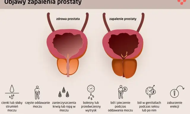 Zapalenie prostaty może powodować objawy takie jak cienki lub słaby strumień moczu, ból, pieczenie, a nawet zaburzenia erekcji.
