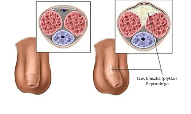 Przekrój prącia pokazuje twardy guzek pod skórą, tzw. blaszkę Peyroniego, która może powodować ból i zniekształcenia.