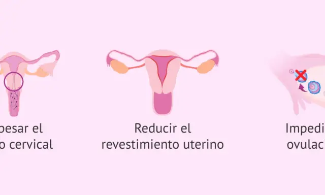 Ilustración de métodos anticonceptivos: espesa el moco cervical, reduce el revestimiento uterino e impide la ovulación. El diu en España es una opción.