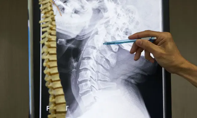 Un medico indica una radiografia della colonna vertebrale cervicale, evidenziando possibili metastasi ossee.
