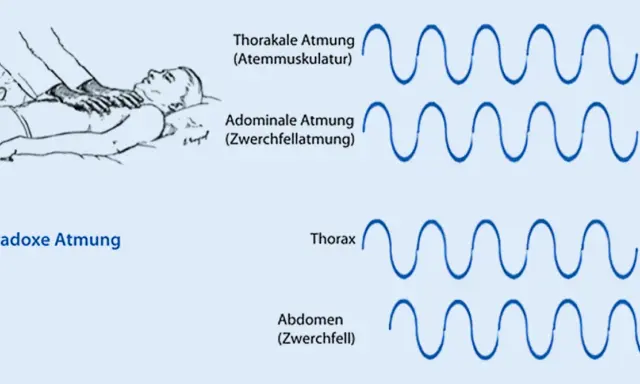Illustration zeigt paradoxe Atmung. Die MRC Skala hilft, die Atmungsmuster zu verstehen: Thorakale vs. Abdominale Atmung und die paradoxe Bewegung von Thorax und Abdomen.