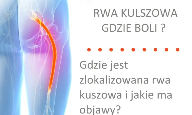 Rwa kulszowa objawy gdzie boli? Grafika pokazuje przebieg nerwu kulszowego, który jest źródłem bólu.