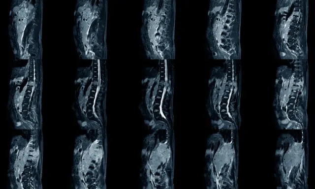 Obrazy MRI kręgosłupa ukazujące chorobę zwyrodnieniową. Widoczne zmiany mogą wpływać na stopień niepełnosprawności.
