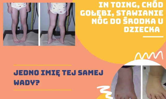 Dziecko z kaczym chodem, stawiające nogi do środka. Dwa zdjęcia pokazują tę samą wadę u dziecka.