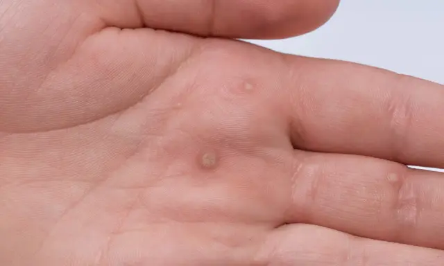 Dłoń mężczyzny z kilkoma brodawkami, które mogą być objawem wirusa HPV. Widoczne zmiany skórne na wewnętrznej stronie dłoni.