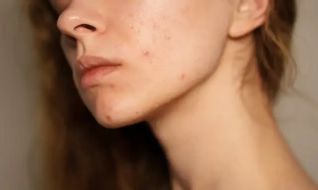 Visage d'une jeune femme avec des rougeurs et des marques de cicatrice acné sur la joue et le menton.