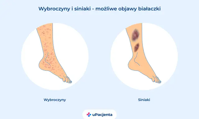 Wybroczyny i siniaki na nogach mogą być objawami białaczki. Czy z białaczką można żyć? Tak, dzięki nowoczesnemu leczeniu.