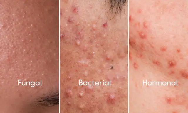 Comparación de tipos de acné: Fungal, con pequeños bultos; Bacterial, con pústulas y granos; Hormonal, con rojeces y protuberancias.