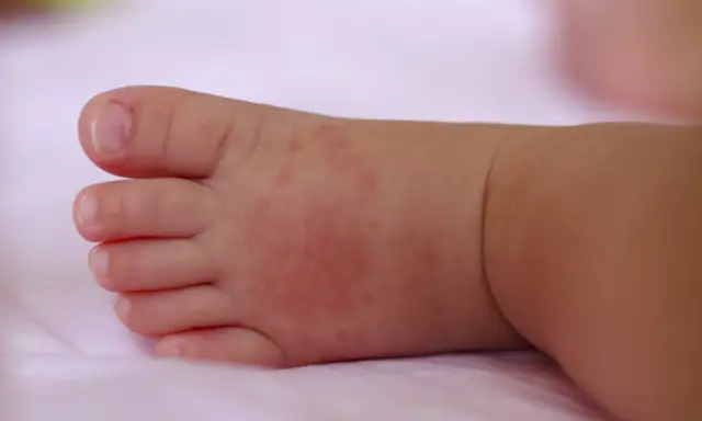 Piedino di neonato con piccoli puntini da sudore rossastri sulla pelle.