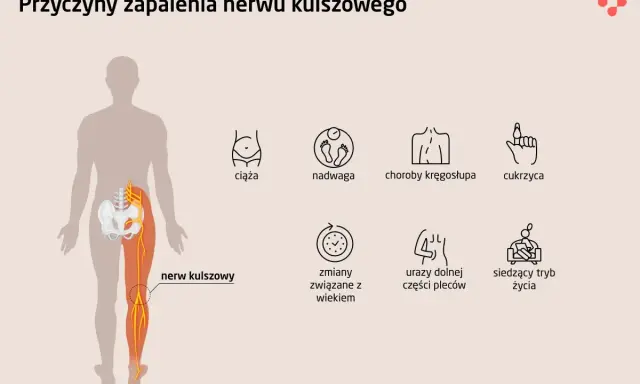 Ból i opuchlizna po przewianiu? To może być zapalenie nerwu!