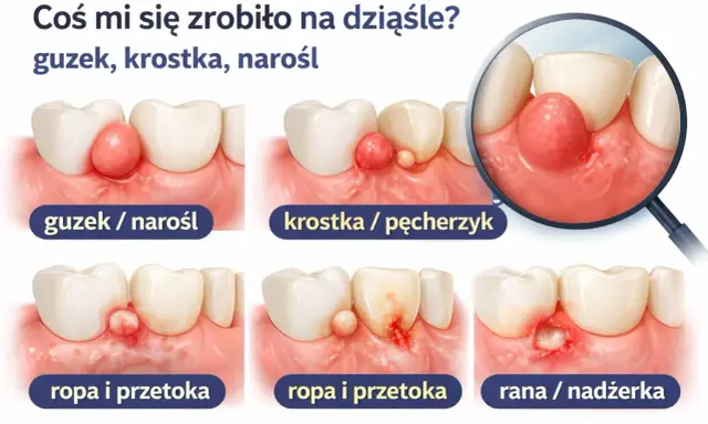 Ilustracja pokazuje różne zmiany na dziąśle: guzek, krostkę, ropień i ranę. Włókniak na dziąśle może przybierać różne formy.