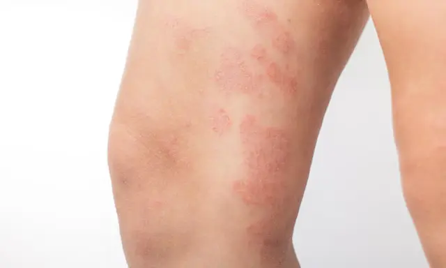 Plaques rouges et squameuses sur la cuisse, indiquant un **eczéma cuisse**. La peau semble irritée et sèche.
