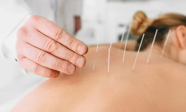 Dłoń terapeuty aplikuje igły do akupunktury na plecach pacjentki. To pokazuje, czym jest akupunktura.