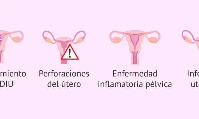 Ilustración de útero con DIU, deslizamiento, perforación, enfermedad inflamatoria pélvica e infección uterina. Reposo tras colocar el DIU Mirena.