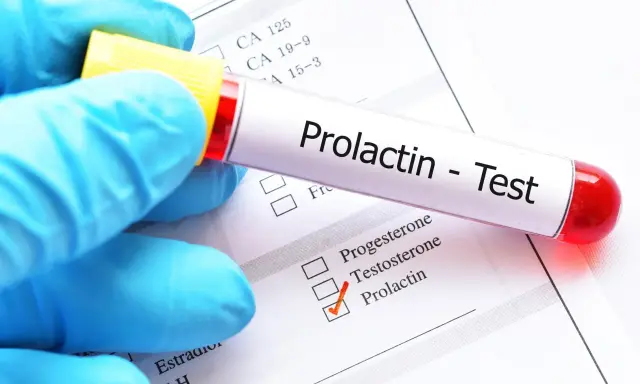 Hiperprolaktynemia: objawy, diagnostyka i jak obniżyć prolaktynę?