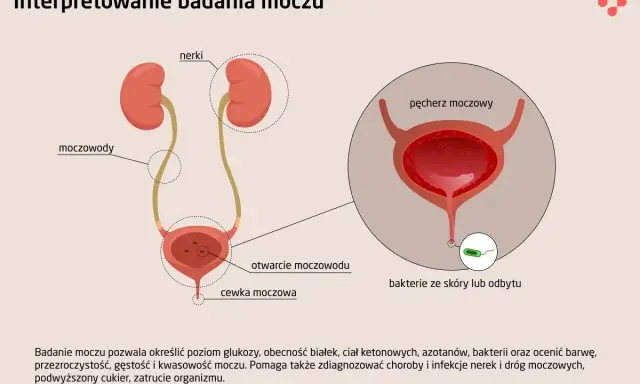 Schemat układu moczowego z nerkami, moczowodami, pęcherzem i cewką. Ilustracja pokazuje różne rodzaje moczu i bakterie.