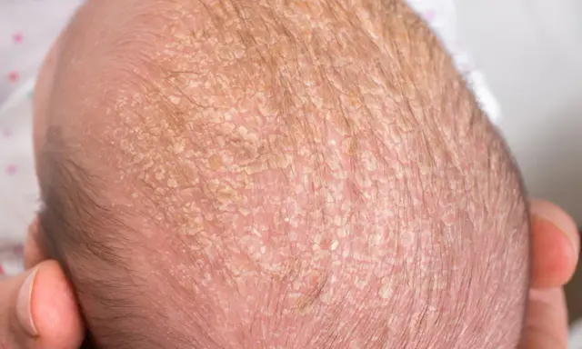 Testa di neonato con crosta lattea, squame giallastre e sottili capelli scuri.