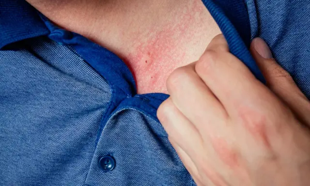 Pelle arrossata e irritata sul collo, possibile dermatite da stress. Una mano solleva il colletto di una camicia blu.