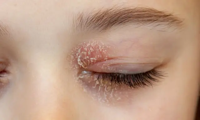 Gros plan sur un œil fermé présentant une peau sèche et squameuse, signe d'une mycose autour des yeux.
