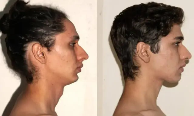 Comparación de perfiles faciales. El lado izquierdo muestra una mandíbula retraída, mientras que el derecho, tras practicar que es mewing, revela un perfil más definido.