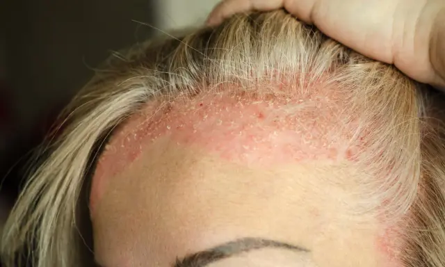 Cuir chevelu irrité avec des plaques rouges et des squames de peau morte, près des cheveux blonds.