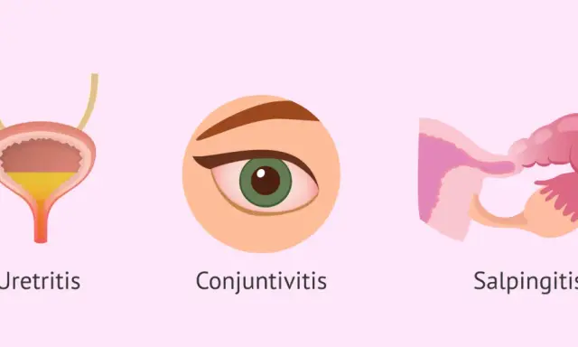 Ilustración muestra uretritis, conjuntivitis y salpingitis, afecciones que puede causar la clamidia.