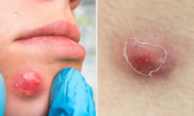 Gros bouton douloureux sur la joue, rouge et enflammé, prêt à percer. Gros plan sur une lésion cutanée similaire.