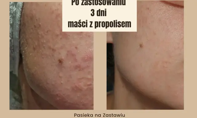 Przed i po 3 dniach stosowania maści z propolisem. Skóra z niedoskonałościami staje się gładsza.