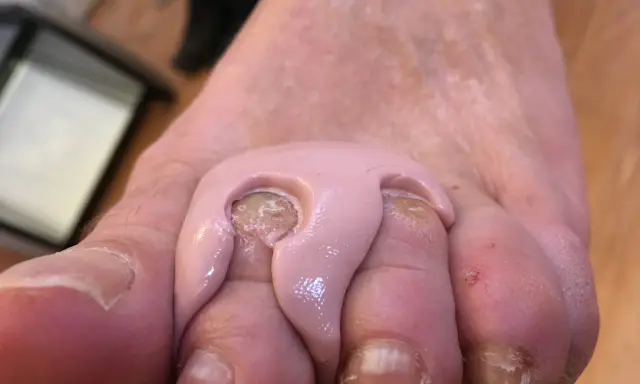 Orthoplastie podologue : un pansement rose est appliqué entre les orteils pour soulager une douleur.