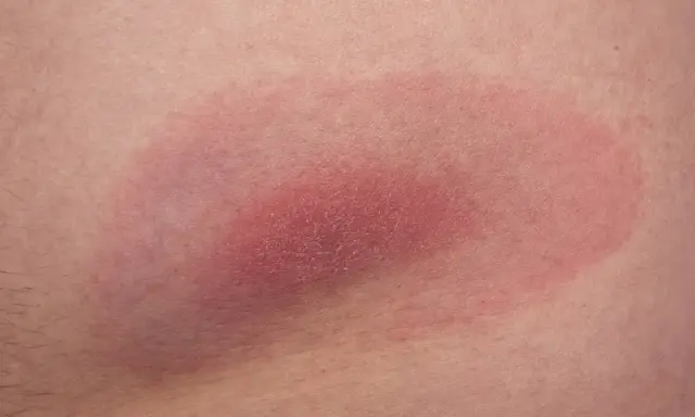 Rumień wędrujący, objaw kleszcza pod skórą, rozszerza się. Czerwona plama na skórze.