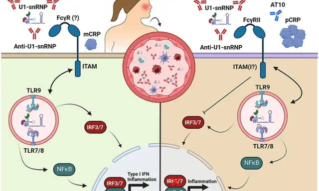 Schema illustra meccanismi infiammatori mediati da anticorpi anti-U1-snRNP e proteina C reattiva (pCRP).