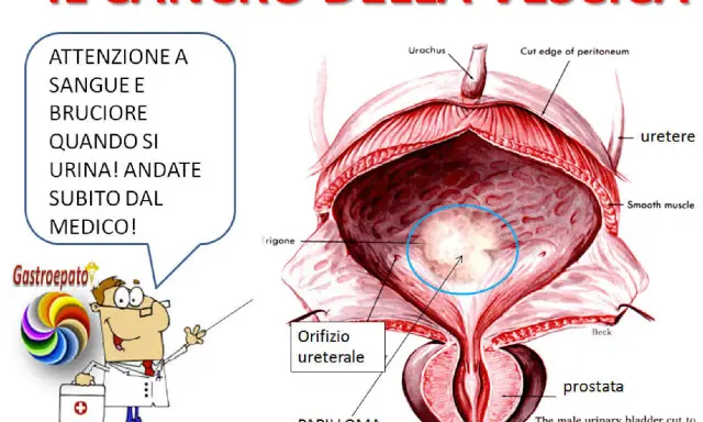 Illustrazione anatomica della vescica maschile con un'area evidenziata che indica un tumore alla vescica. Avviso: sangue e bruciore durante la minzione richiedono visita medica immediata.