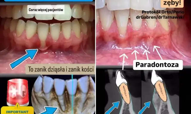 Zanikanie dziąseł i kości (paradontoza) może prowadzić do utraty zębów. Sprawdź, jaka jest recesja dziąseł cena leczenia.
