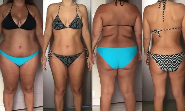 Avant/après : une femme en bikini montre sa silhouette, avec une perte de hanches visible.