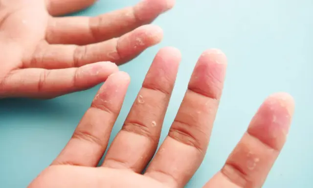 Mains affectées par la dyshidrose, avec des vésicules et une peau qui pèle sur les doigts.