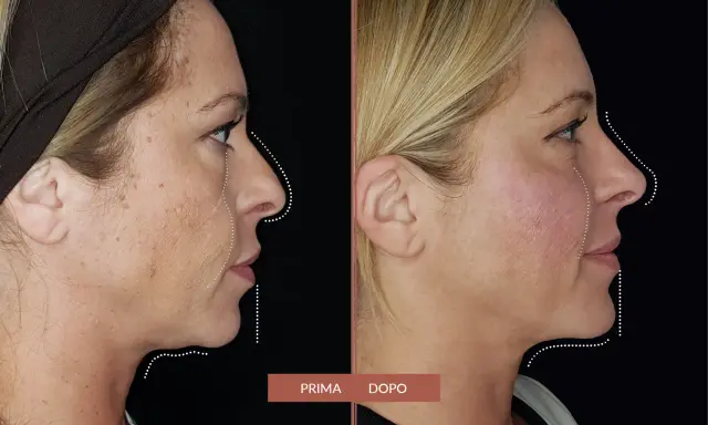 Prima e dopo: il filler full face ha ridefinito i contorni del viso, migliorando la pienezza e la definizione.