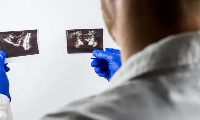 Lekarz w niebieskich rękawiczkach analizuje dwa zdjęcia USG, szukając odpowiedzi na pytanie: rak prostaty ile się żyje.