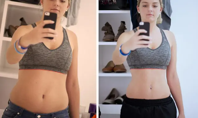 Kobieta w sportowym topie robi sobie selfie, pokazując brzuch przed i po zabiegu.