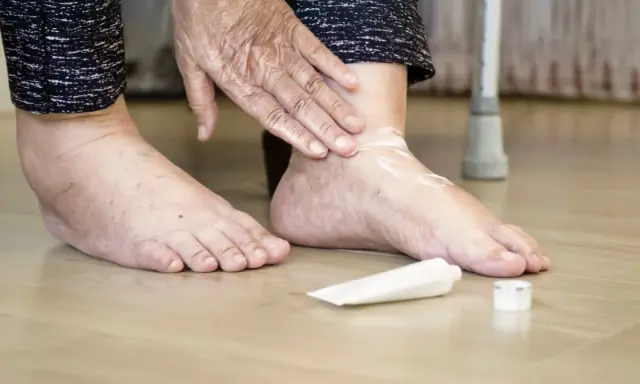 Osoba smaruje stopę kremem, łagodząc ból dużego palca w stopie, który może być związany z cukrzycą.