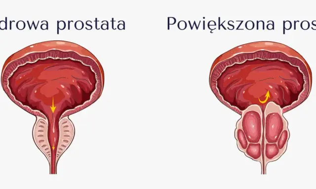 Porównanie zdrowej i powiększonej prostaty. Powiększona prostata może powodować problemy z oddawaniem moczu, co jest jednym z objawów przerostu gruczołu krokowego.