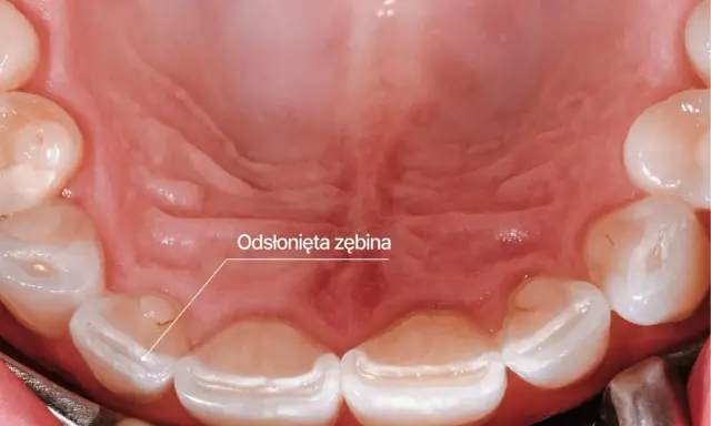 Widoczne odsłonięte zęby, oznaka bruksizmu. Zwróć uwagę na ścieranie szkliwa, by rozpoznać problem.