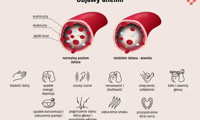 Objawy anemii: bladość, zmęczenie, bóle głowy. Leczenie anemii jest kluczowe dla poprawy samopoczucia.