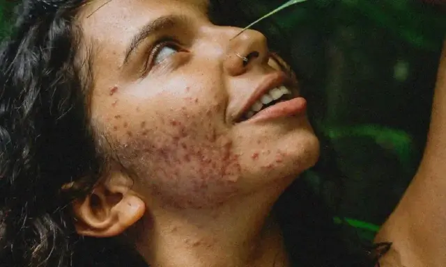 Visage d'une jeune femme aux cheveux sombres, le regard levé, présentant une acné inflammatoire marquée sur la joue et le cou. Une feuille verte effleure son front.