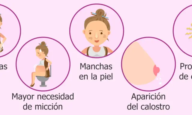 Ilustración de síntomas de embarazo: estrías, mayor necesidad de micción, manchas en la piel, aparición del calostro y problemas de espalda.